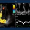 Images Doppler et cardiologie de l' échographe Hitachi Eub