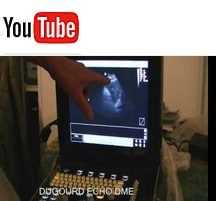 Demonstration vidéo de l' echographe Chison ECO 3