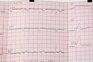 Électrocardiogrammes